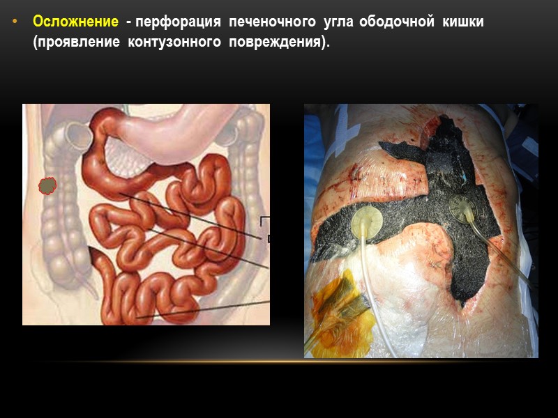 Осложнение - перфорация печеночного угла ободочной кишки (проявление контузонного повреждения).  3 релапаротомии СПОН,